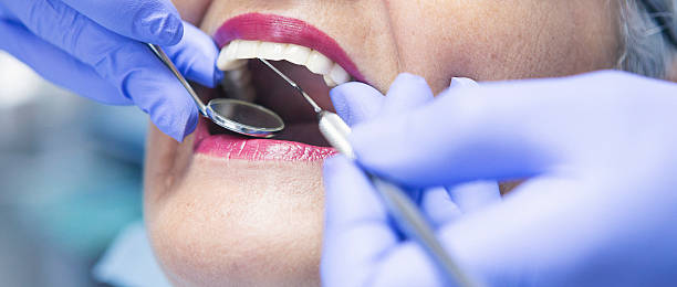 Best Emergency Dentist for Lost Fillings or Crowns in Mooresville, NC